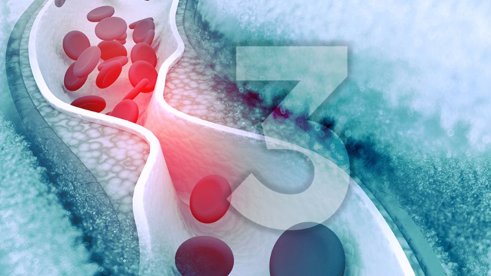 El colesterol alto puede tapar las arterias. Fuente: producción Panorama