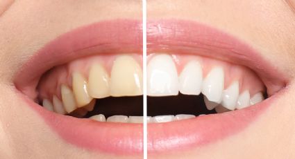 5 consejos para elegir el mejor blanqueamiento dental