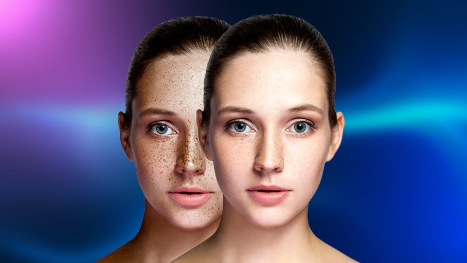 Despídete de las manchas e imperfecciones en el rostro. Fuente: Producción Panorama