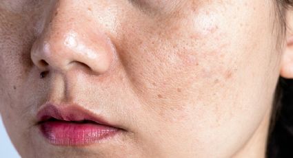 ¿Por qué aparece el melasma? las manchas marrones en la piel del rostro