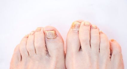 El remedio casero que recupera las uñas de los pies para lucir sandalias este verano